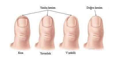 Tırnak Batmasını Engellemek İçin Ne Yapılmalı ?
